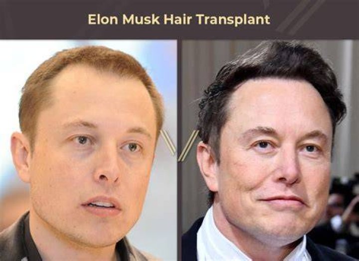Certain Pictures Of Elon Musk Before and After Hair Transplant Are Still On The Internet, But Are The Rumors True?