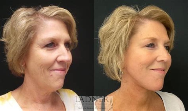 
Did Amy Grant Get A Facelift Surgery? Plastic Surgery Before And After 