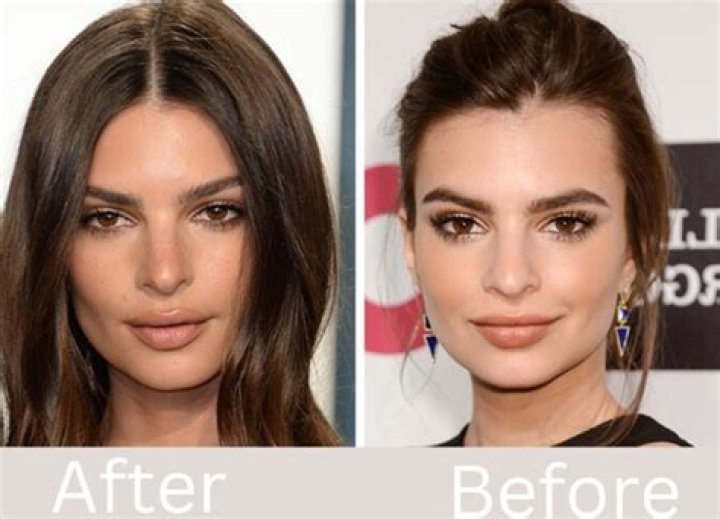 Did Emily Ratajkowski Have Breast Augmentation? Boob Job And Surgery Update