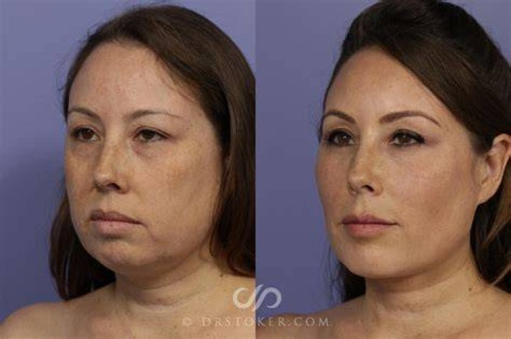 
Did Stassi Schroeder Get Plastic Surgery? Stassi Schroeder Before and After 