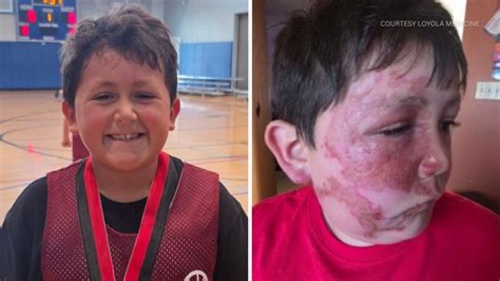 
Dominick Krankall, A 6 Year Old Was Burned By A Bully In Bridgeport, Connecticut 
