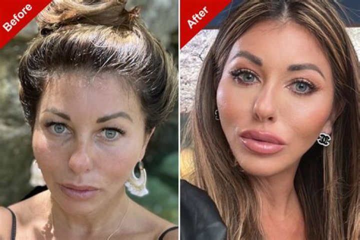 Has The Bachelorette’s Gabby Windey Done Plastic Surgery? Explore Her Before And After Photos