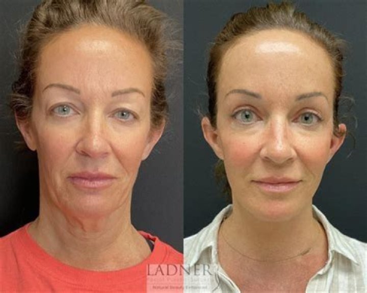 Pam Anderson | Facelift Surgery | Before And After