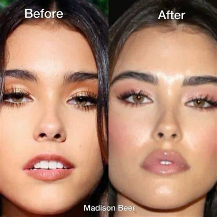
What Happened To Madison Beer Jaw? Weight Loss Before And After: Has She Done A Plastic Surgery? 